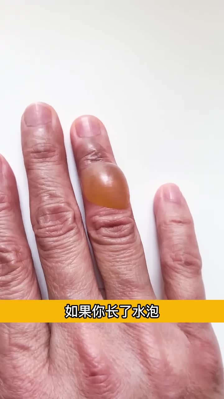 长水泡后到底能不能戳破解释