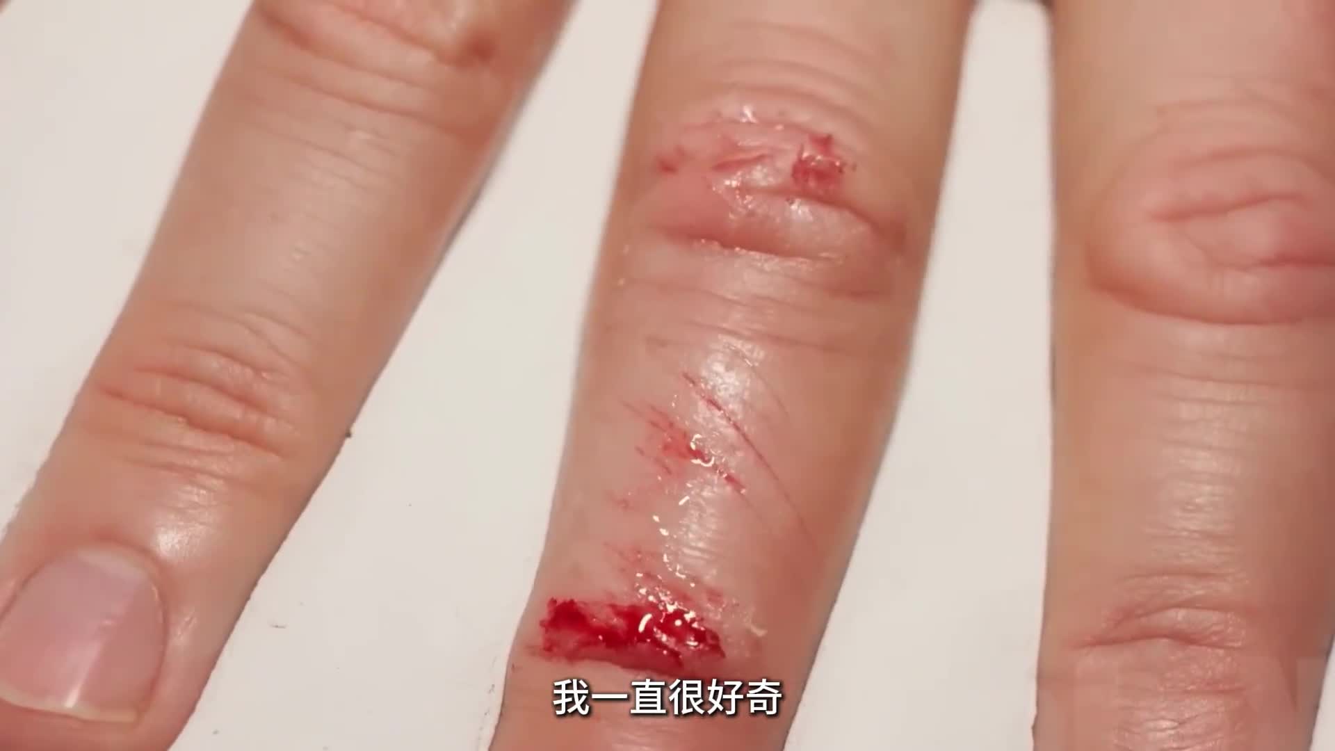 伤口是如何自愈的带你看伤口愈合全过程可不要乱扣伤疤