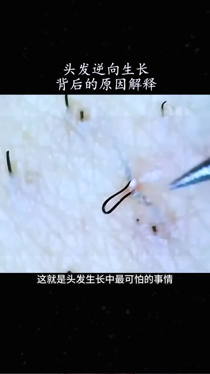 遇到头发向内生长该怎么办