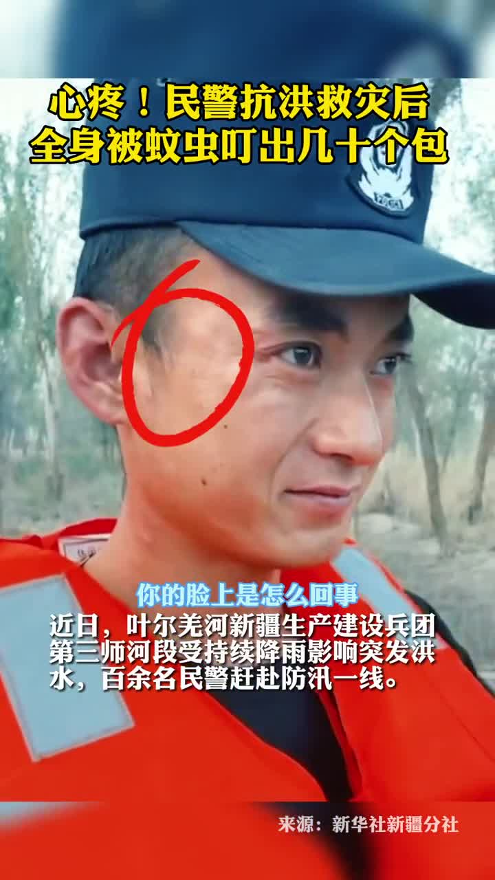 心疼民警抗洪救灾后全身被蚊虫叮出几十个包