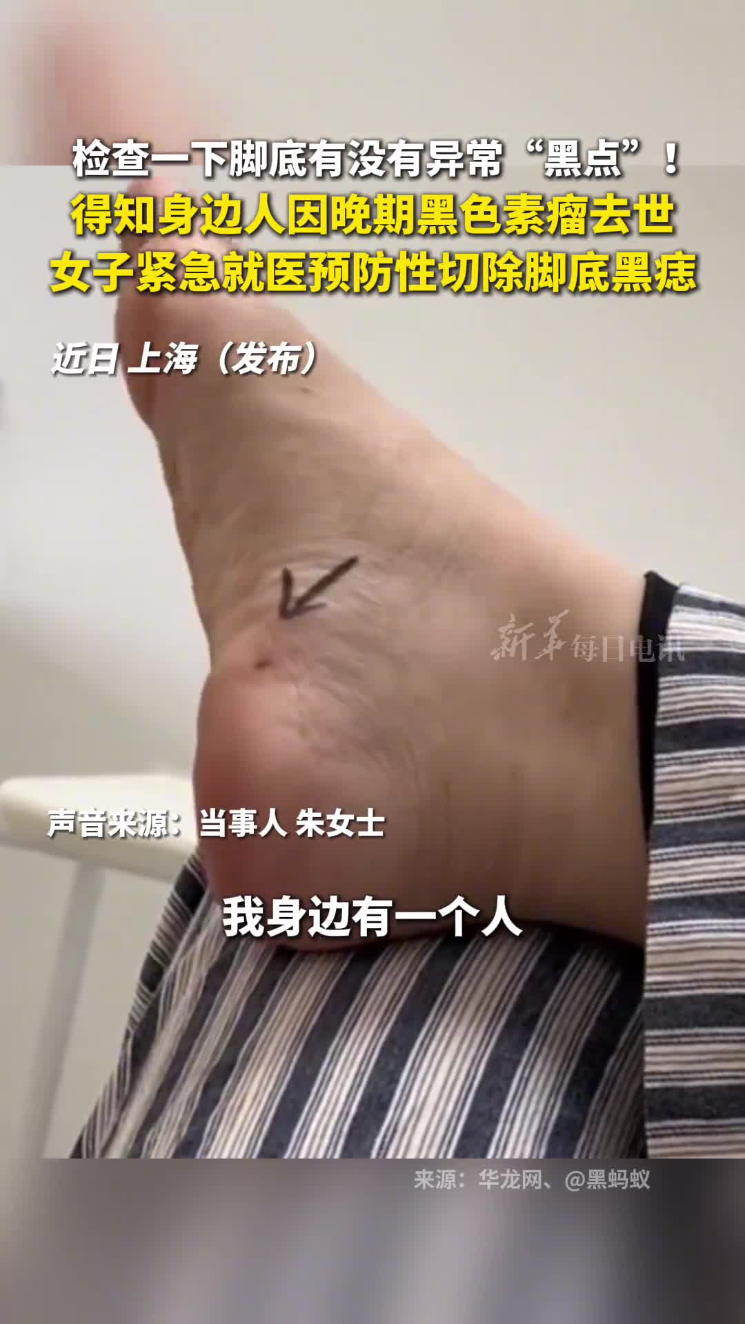 检查一下脚底有没有异常黑点得知身边人因晚期黑色素瘤去世女子紧急就医预防性切除脚底黑痣
