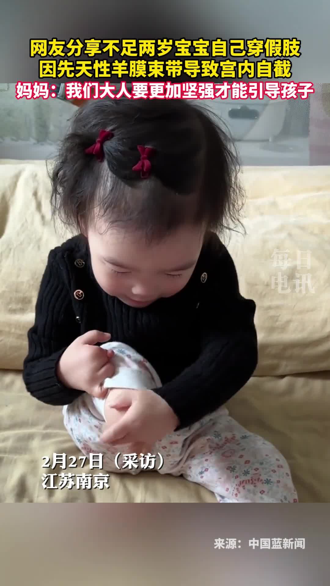 网友分享不足两岁宝宝自己穿假肢因先天性羊膜束带导致宫内自截妈妈我们大人要更加坚强才能引导孩子