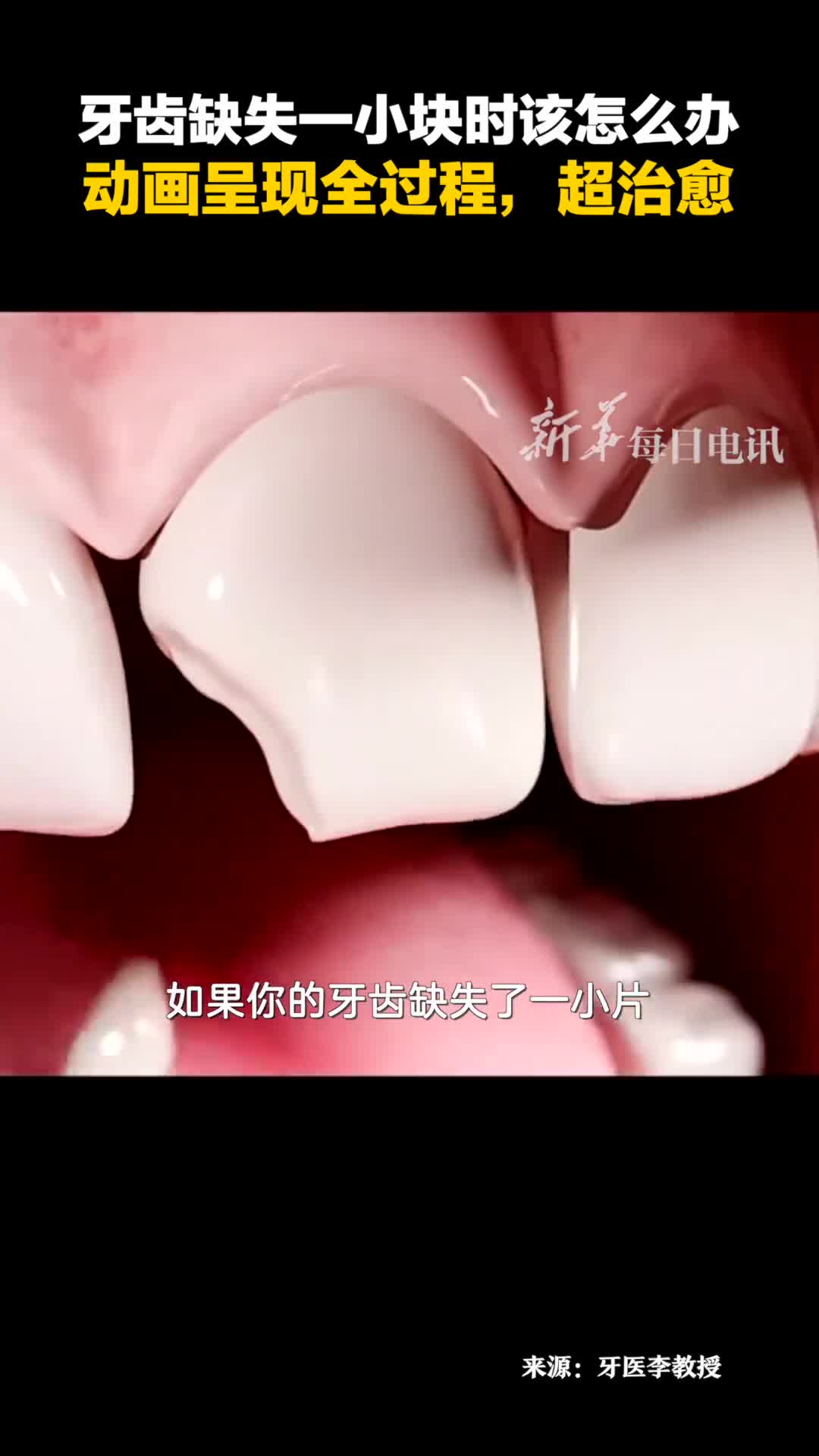 牙齿缺失一小块时该怎么办动画呈现全过程超治愈