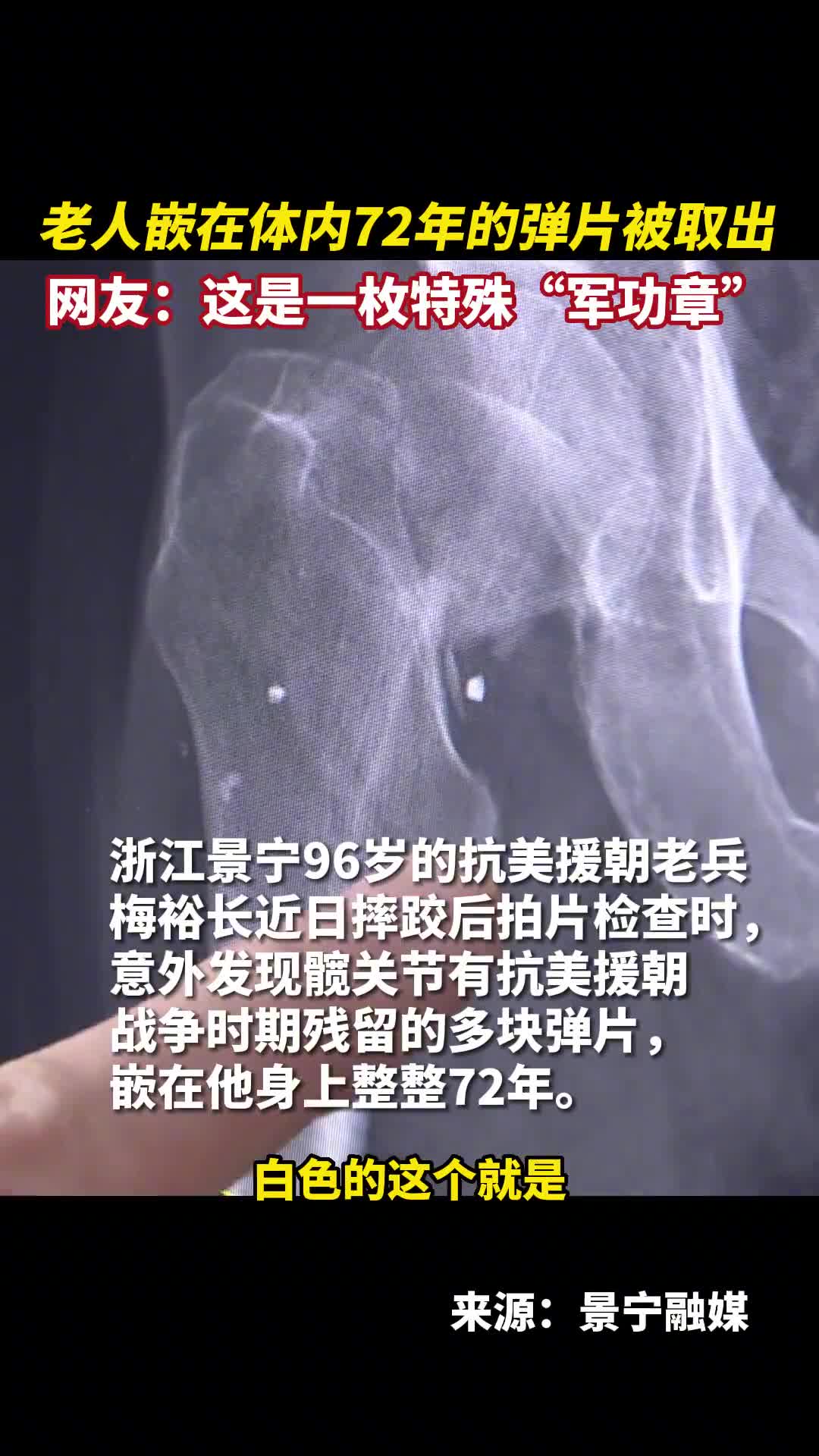老人嵌在体内72年的弹片被取出网友这是一枚特殊军功章