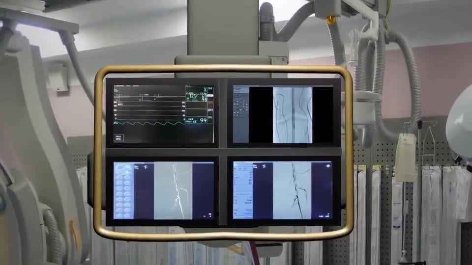 动画展示血栓清除微创手术跟下水道清淤原理没啥区别
