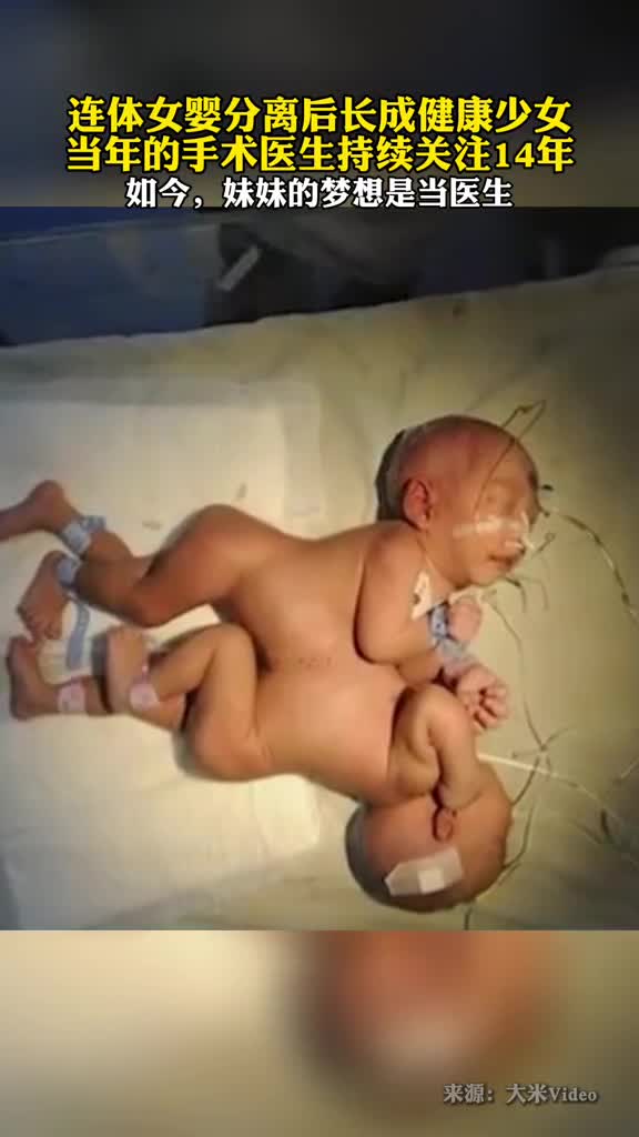 连体女婴分离14年后长成健康少女