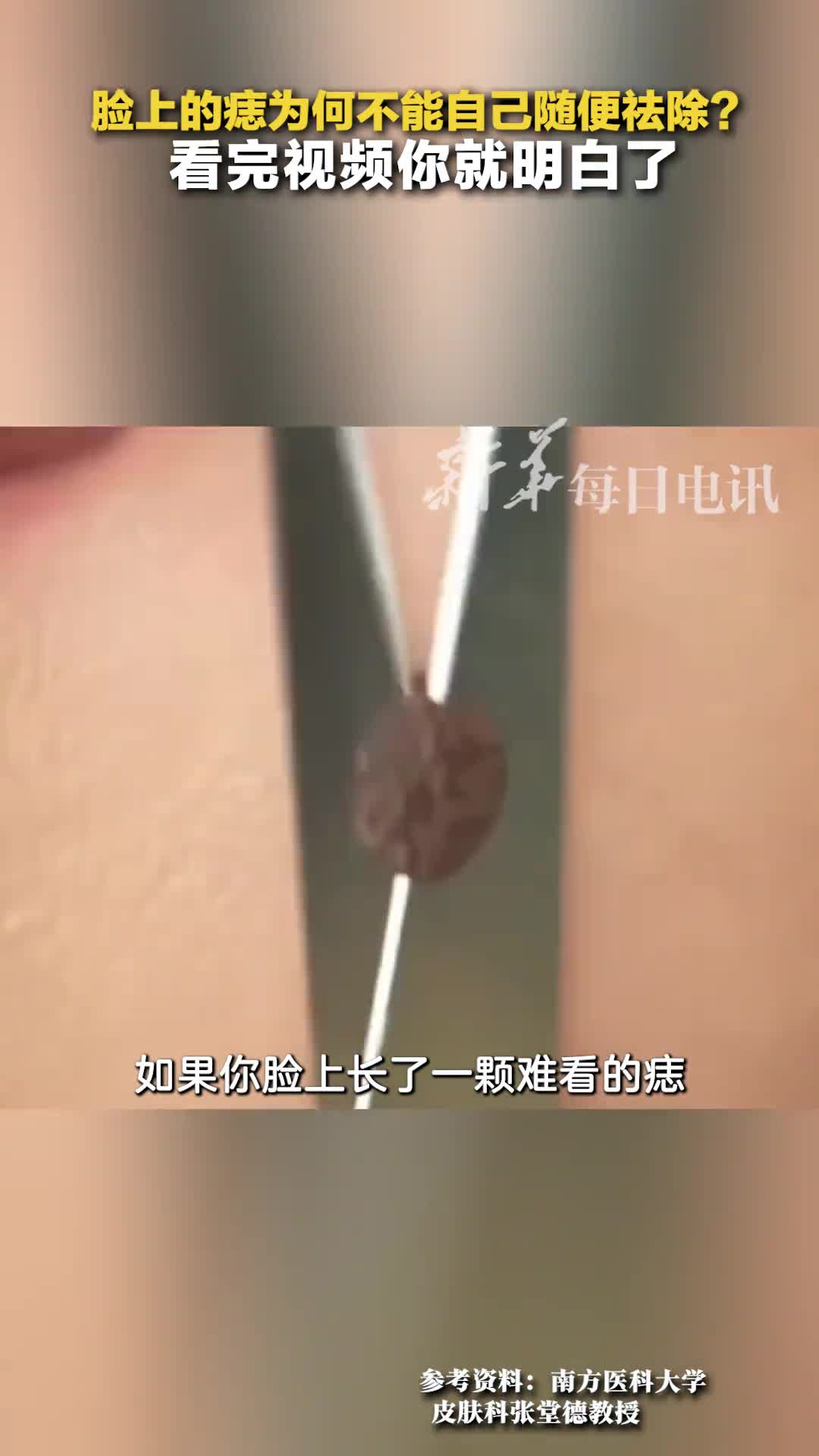 脸上的痣为何不能自己随便祛除