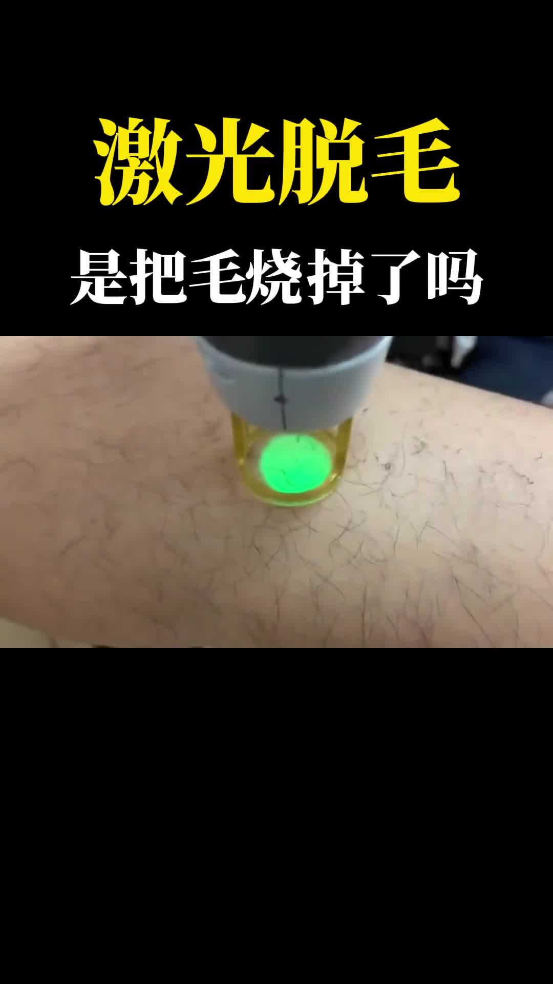 为什么激光照一下毛就蔫了激光脱毛原理是什么
